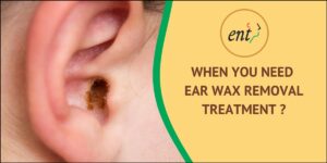 When You Need Ear Wax Removal Treatment